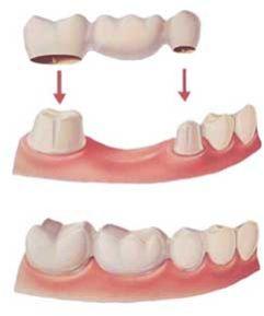 dental bridge