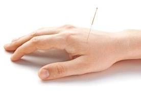 acupuncture treatment services