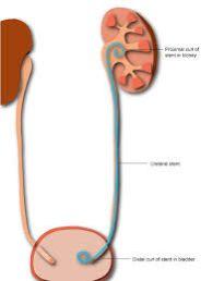 Ureteral Stent