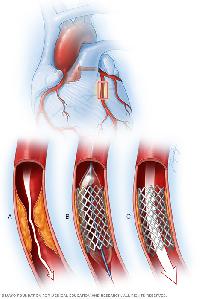coronary angioplasty stent
