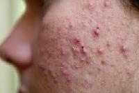 acne treatment services