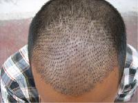 Hair Transplantation