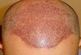 fue hair transplant treatment