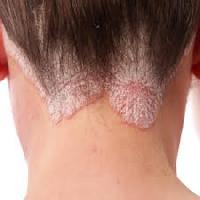 Scalp Psoriasis Treatment