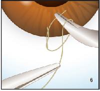 suture needles