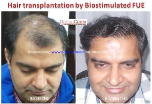 Hair Transplant Services