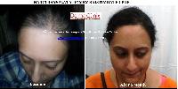 Hair Transplant surgery