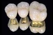 dental alloys