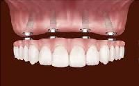 Dental Implants