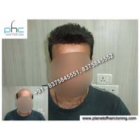 NON SURGICAL HAIR REPLACEMENT SYSTEMS
